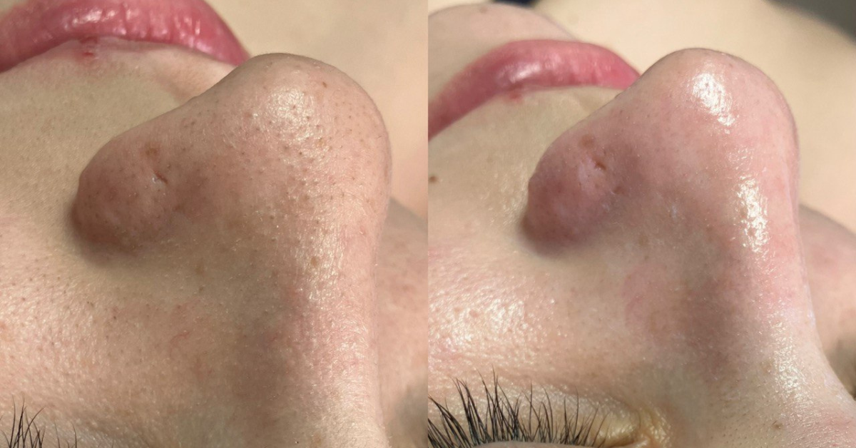 antes e depois limpeza de pele amat estetica porto.png