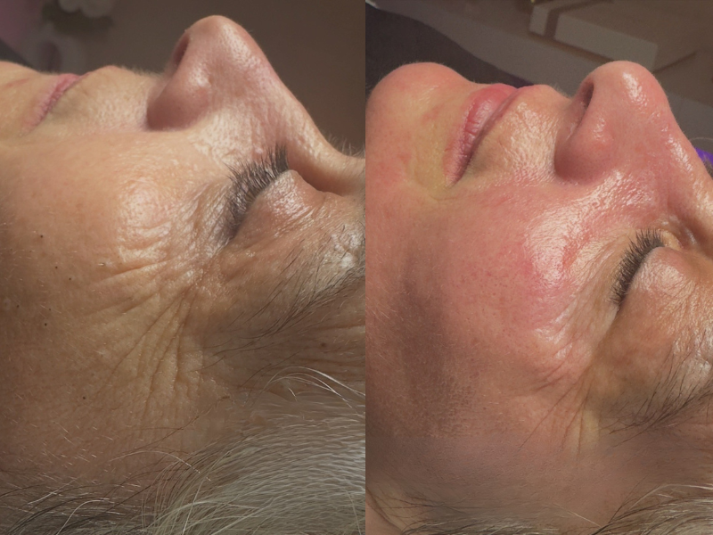 Resultado visível antes e depois do tratamento com limpeza de pele profunda e radiofrequência facial.