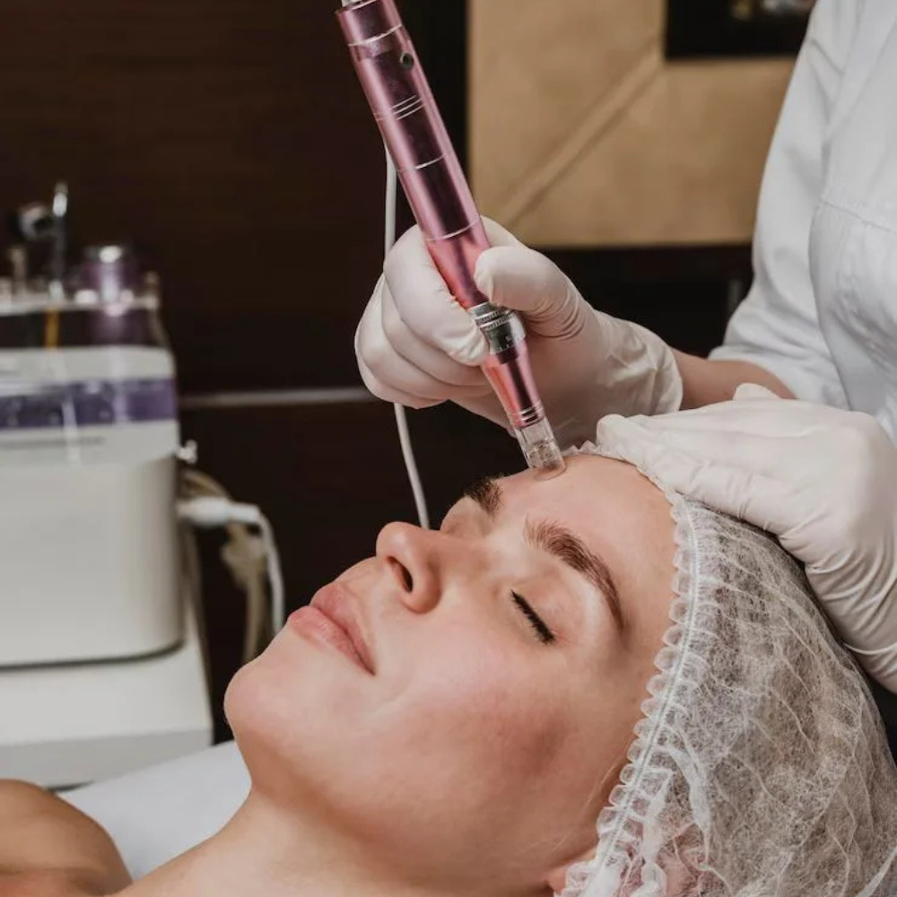 microagulhamento facial dermapen