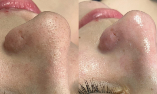 antes e depois limpeza de pele amat estetica porto.png