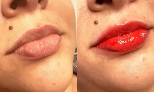 Cuidados Pós-Hydra Lips Gloss com Dermapen