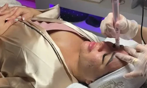 Cuidados Pós-Microagulhamento com Dermapen
