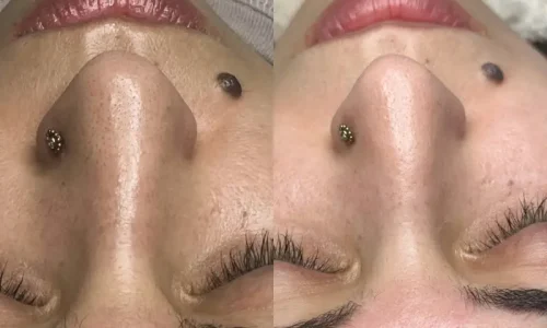 Cuidados Pós-Limpeza de Pele – (Todos os protocolos)