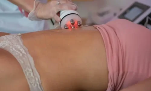 Cuidados Pós-Radiofrequência