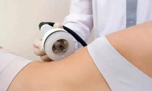 Cuidados Pós-Vácuo com Radiofrequência Corporal