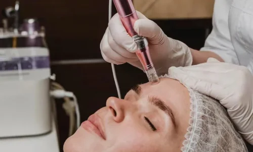 Microagulhamento Facial com Dermapen no Porto: Como Funciona e Quais os Benefícios?