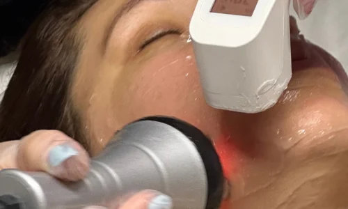Radiofrequência Facial no Porto: Como Funciona a Limpeza de Pele com Radiofrequência?
